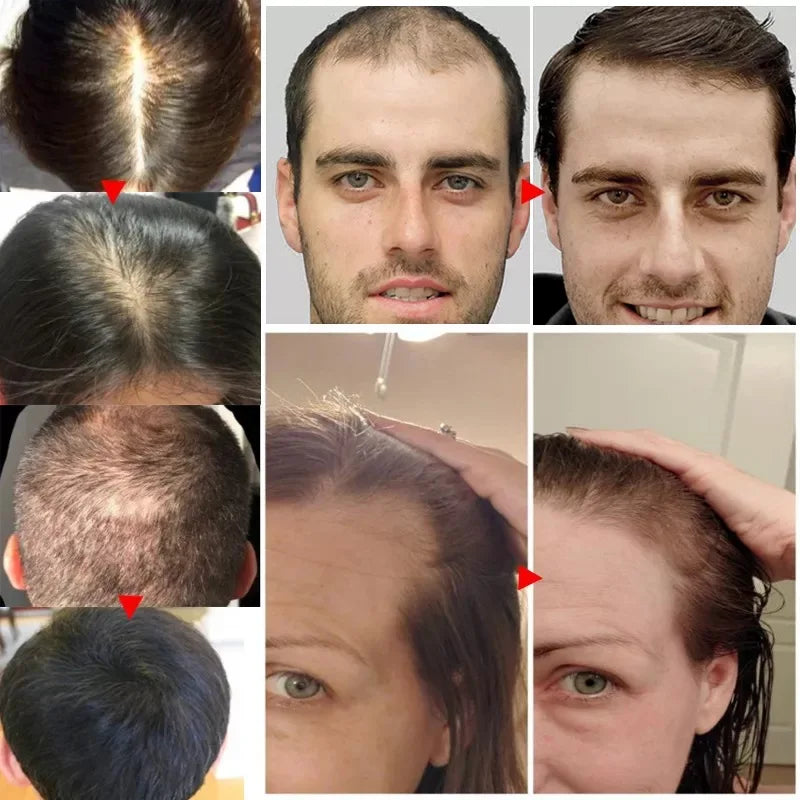 2023 Biotin Fast Hair Growth Oil  Regrowth Serum  Thinning Treatment   Liquid Anti- Loss for Women & Men
