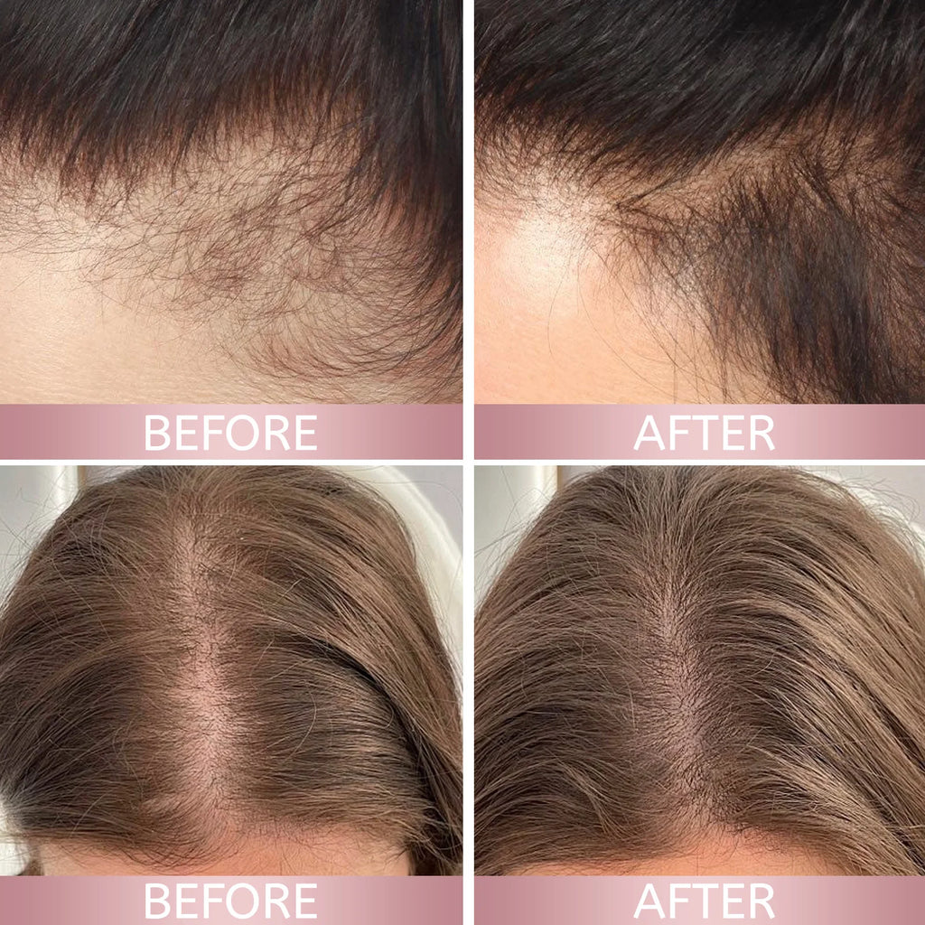 H-REGROW 2.0 Rice Nutri Hair Spray 50ml, Biotin Caffeine Ginger Rice Protein Infused, Nourishing Scalp Care Spray for Thin & Fragile Hair Daily Use