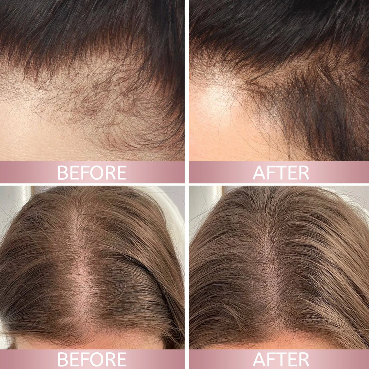 H-REGROW 2.0 Rice Nutri Hair Spray 50ml, Biotin Caffeine Ginger Rice Protein Infused, Nourishing Scalp Care Spray for Thin & Fragile Hair Daily Use