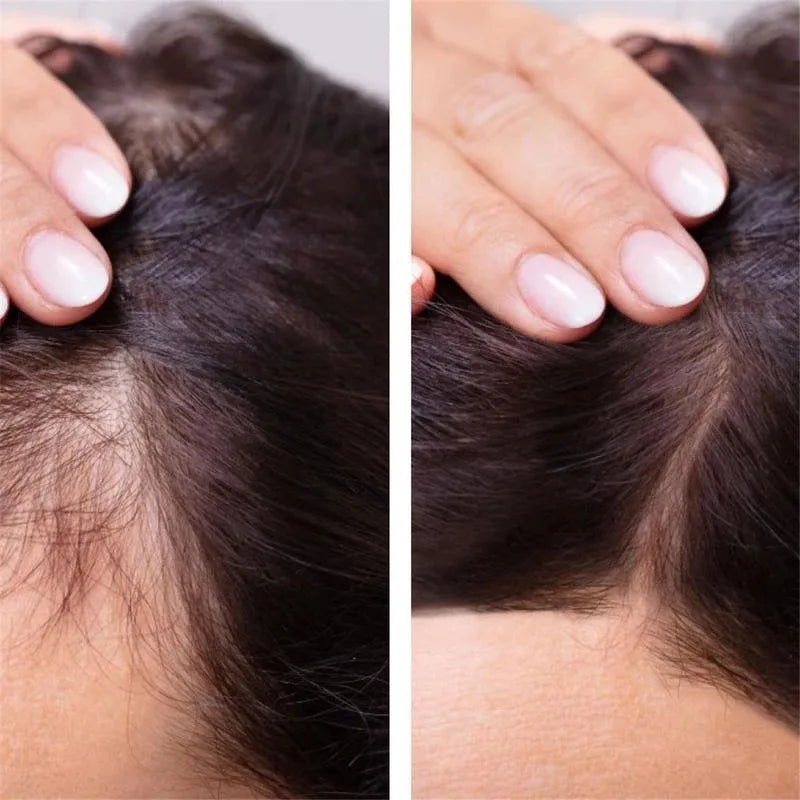 2023 Biotin Fast Hair Growth Oil  Regrowth Serum  Thinning Treatment   Liquid Anti- Loss for Women & Men