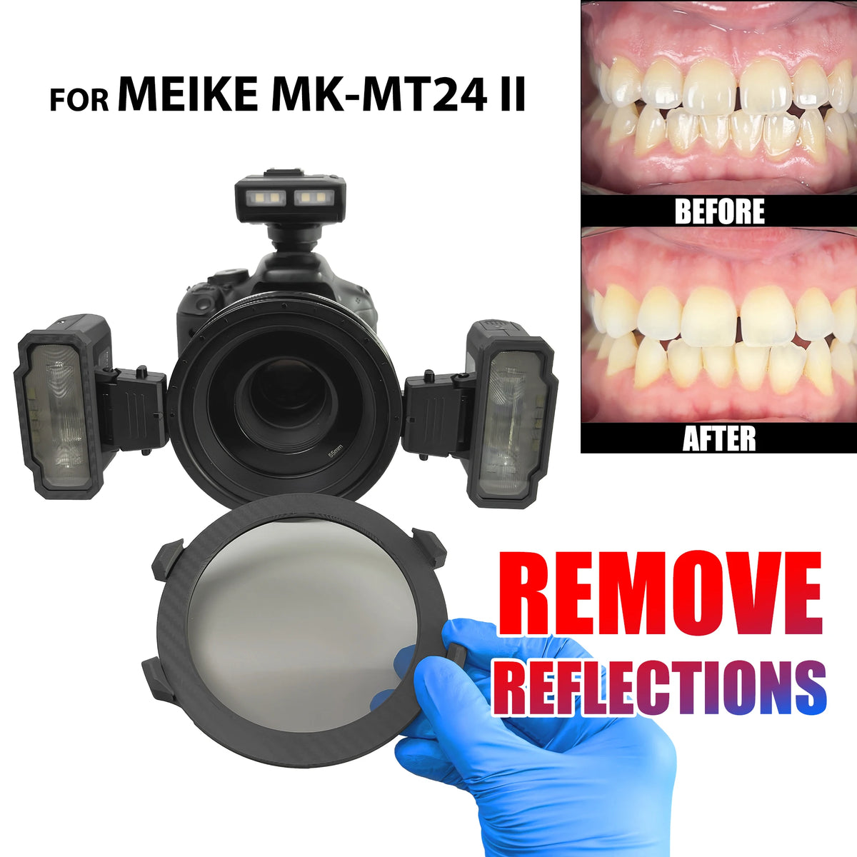 Dental Photo. CPL Polarizing Filter For MEIKE MK-MT24 Flash Set. Remove Reflections And Glare In Dental Photography