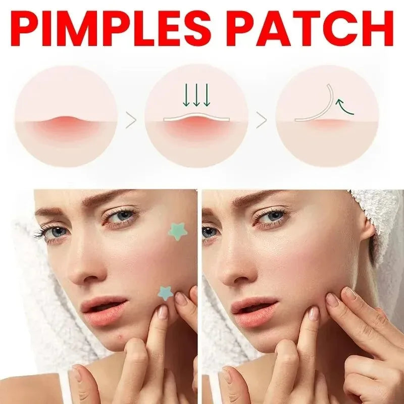200pcs Repair Acne Patch Facial Skin Care Fade Blemishes Pimple Marks Closed Acne Blemishes Cover Acne Pimple Repair Patch
