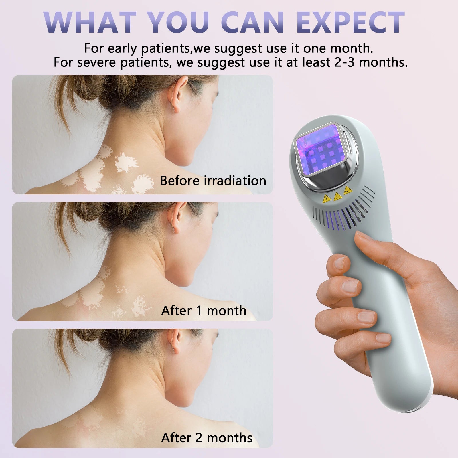 KTS Vitiligo Lamp for Home Use 308nm UVB Lamp for Vitiligo Phototherapy Light Therapy for Psoriasis Spots Eczema Skin Disease