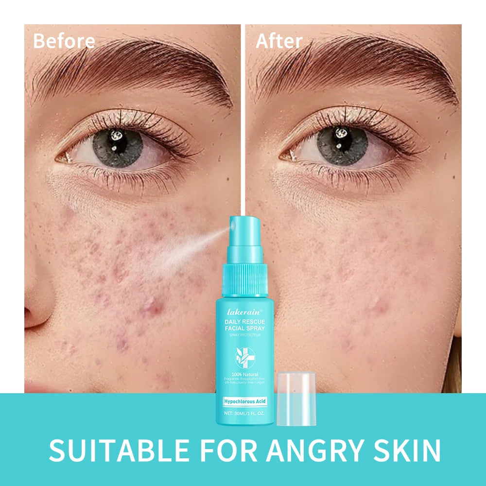 30ml Rescue Facial Spray For Sensitive Skin Hypochlorous Acid Spray Helps Reduce Redness Breakouts Soothing Balancing Spray