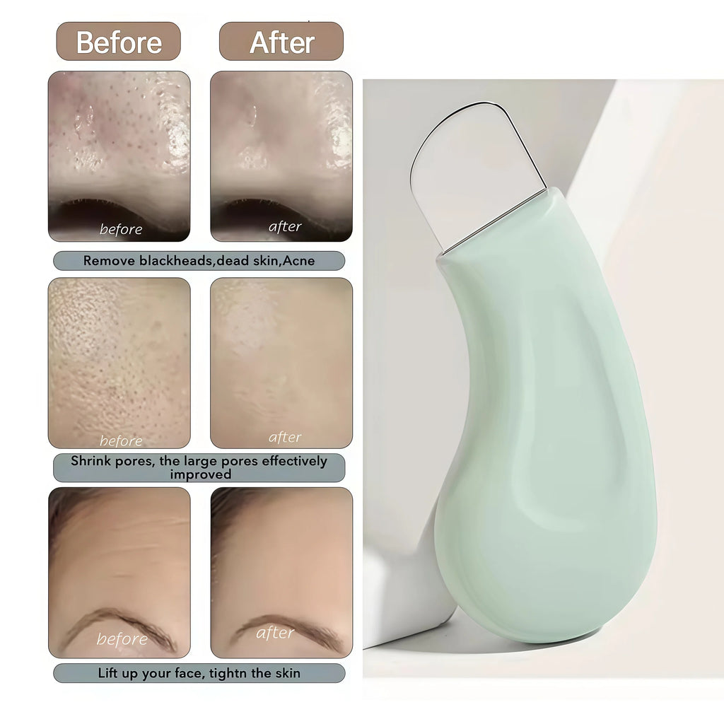 New Cat's Paw Blackhead Removal Tool - Perfect for Removing Pimples and Blemishes, Gentle Pore Cleansing, Exfoliating, Easy to H