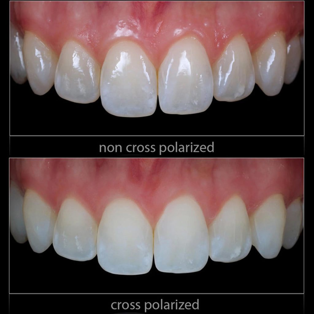 Dental Photo. CPL Polarizing Filter For MEIKE MK-MT24 Flash Set. Remove Reflections And Glare In Dental Photography