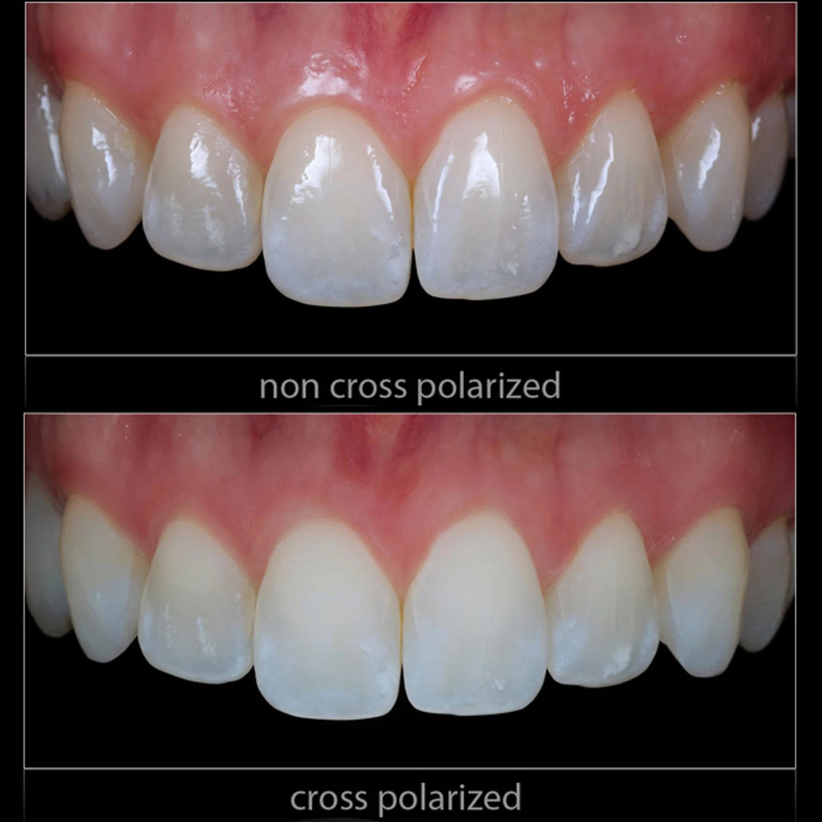 Dental Photo. CPL Polarizing Filter For MEIKE MK-MT24 Flash Set. Remove Reflections And Glare In Dental Photography