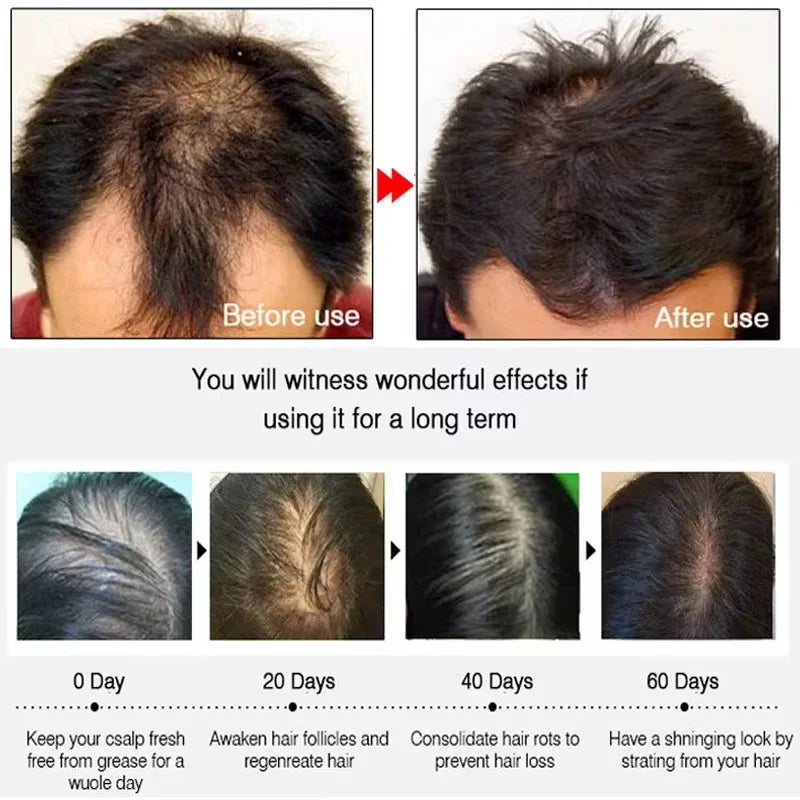 Ginger Hair Growth Spray Anti Hair Fall Hair Loss Treatment Hair Growth Essence Oil for Men Women Hair Treatment